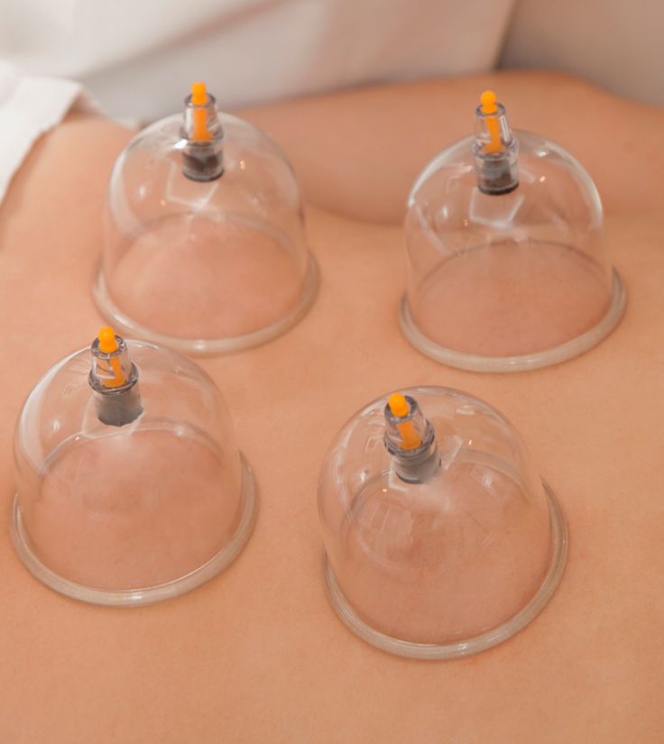 Cupping therapy - Ventosas